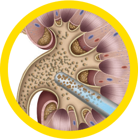 Percutaneous Nephrolithotomy (PCNL)