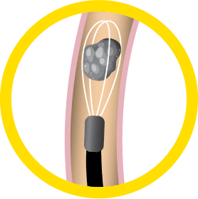 Ureteroscopy