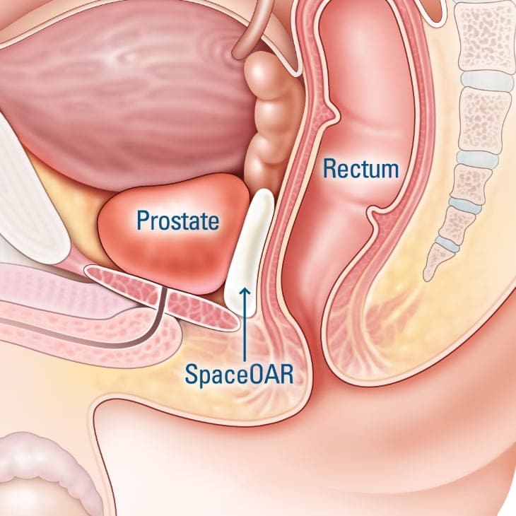 top prostate cancer doctors,best doctors for prostate cancer,best prostate cancer doctors in texas,prostate cancer specialists,top prostate cancer surgeons