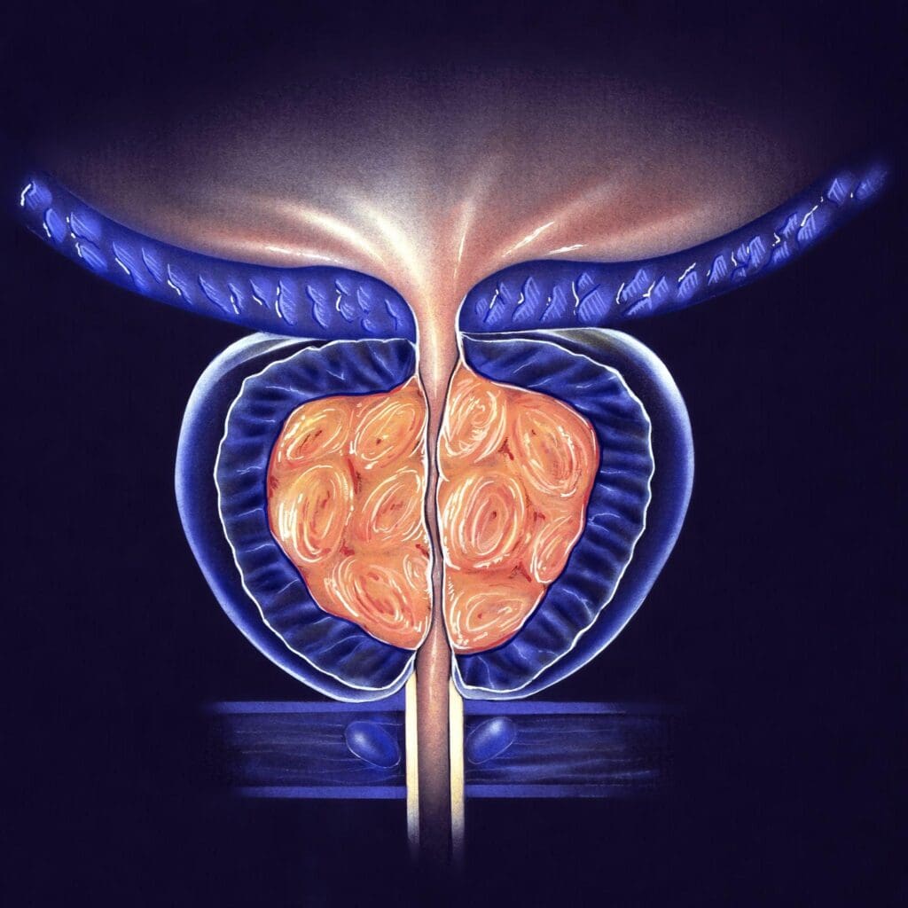 bpc 157 and enlarged prostate BPH (Enlarged Prostate) Symptoms & Treatment | North Texas would bpc 157 help Ascorbic Acid for Injection BPC-157 - Refined Bio (Type):Liquid
