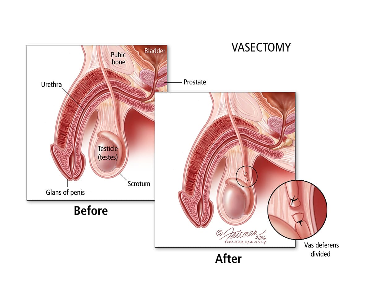 vasectomy-2