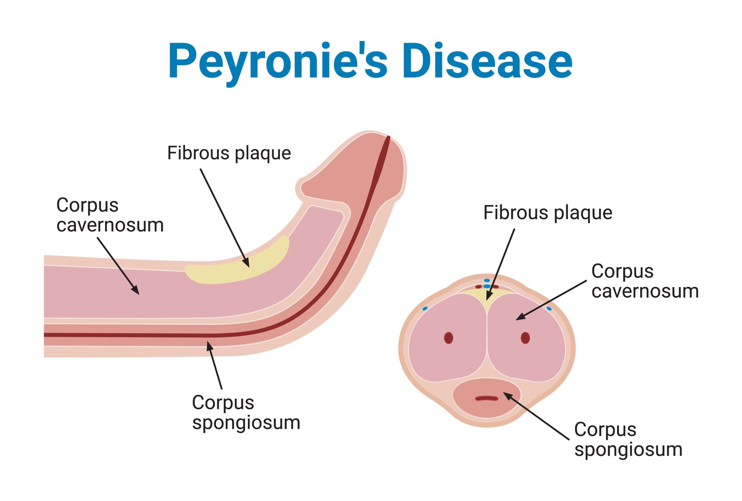 peyroniesdiseasemedicalvectorillustration