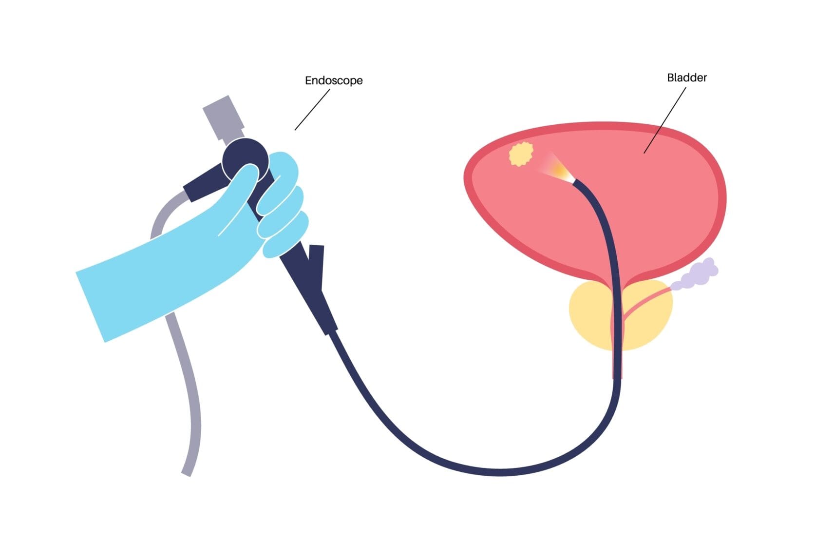 Cystoscopy Procedure For Bladder & Urethra Diagnosis | DFW | UPNT