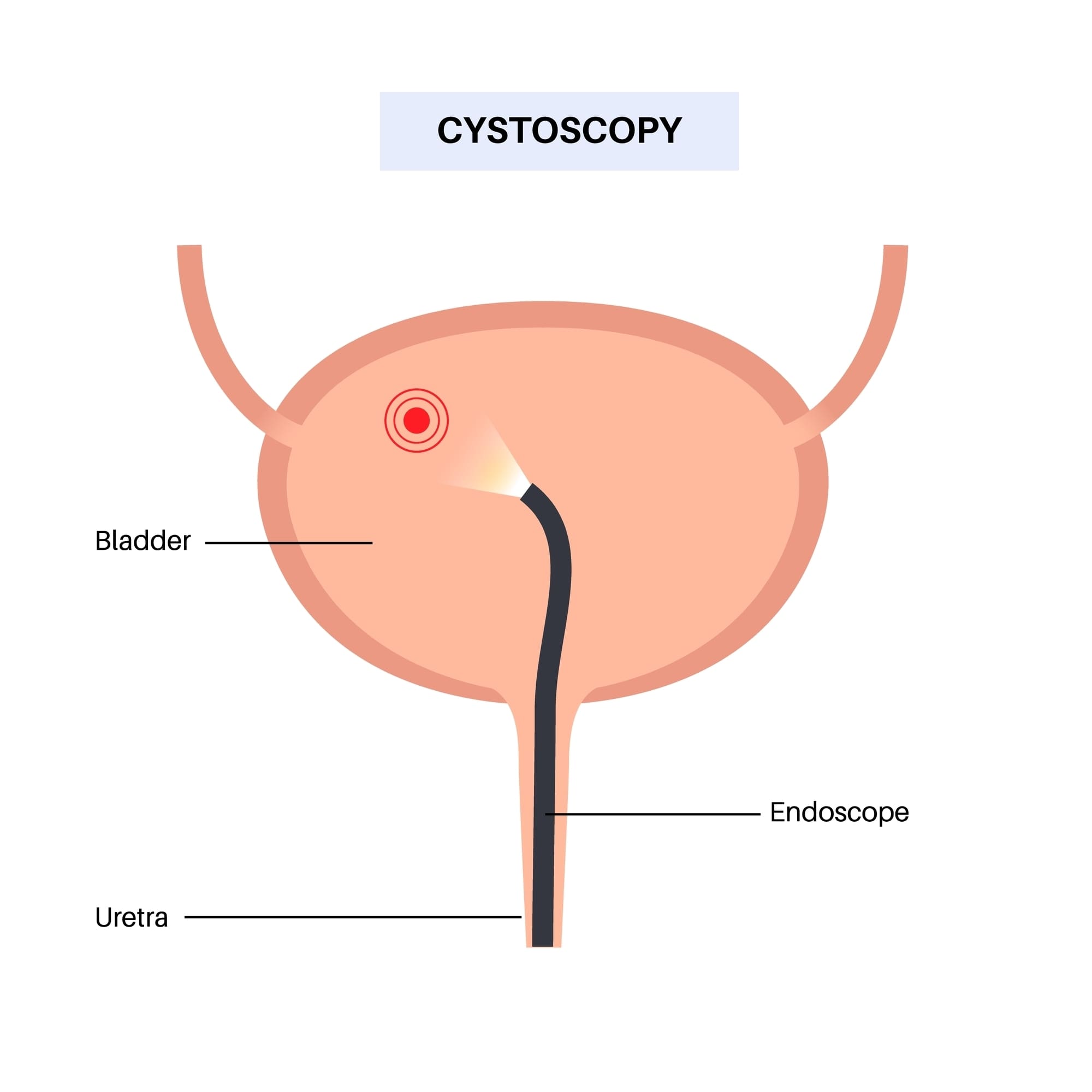 cystoscopyisaminimallyinvasiveprocedure-examinationandtreatmentof