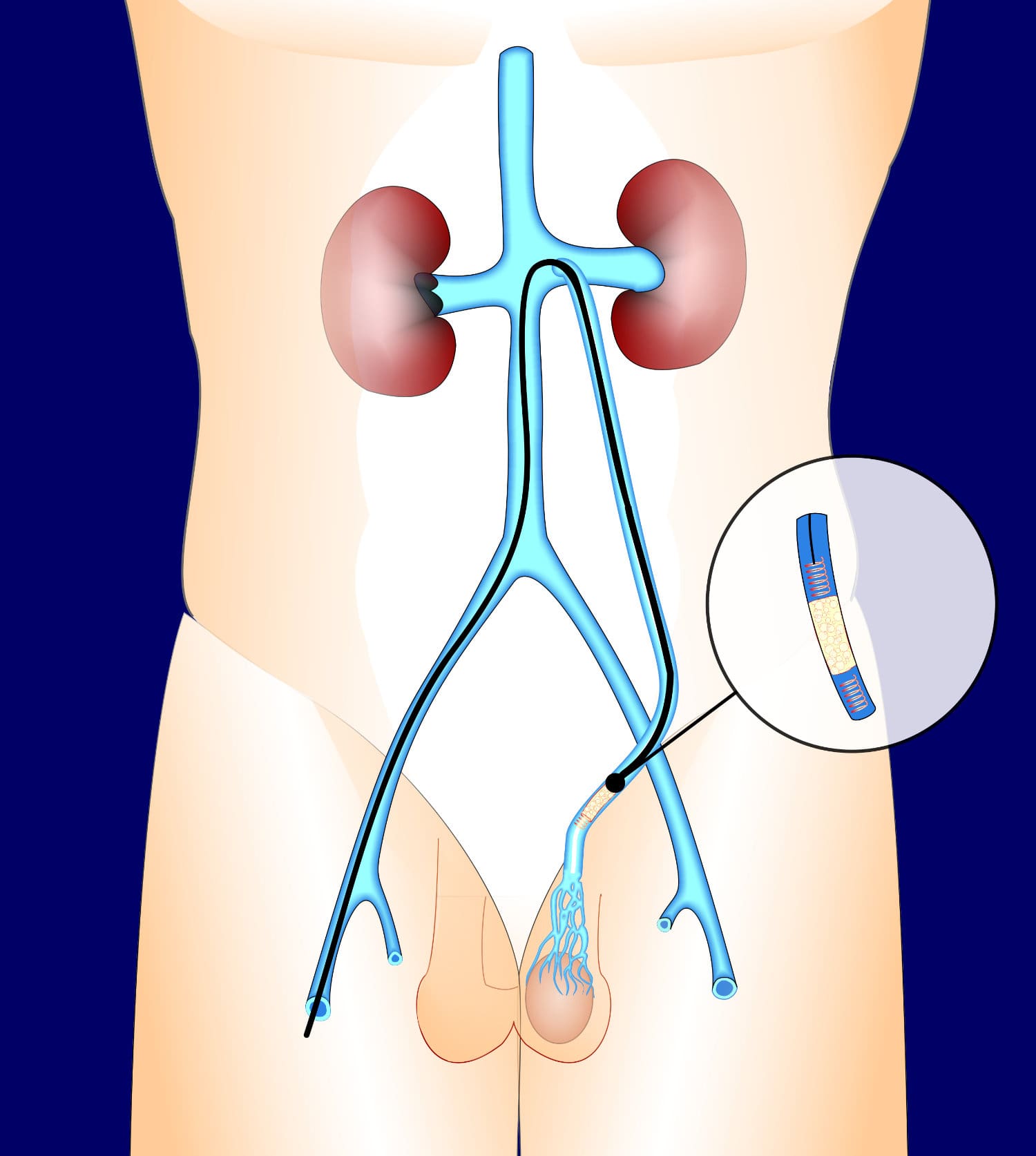 varicoceletreated3