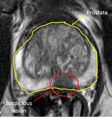 prostate-mri