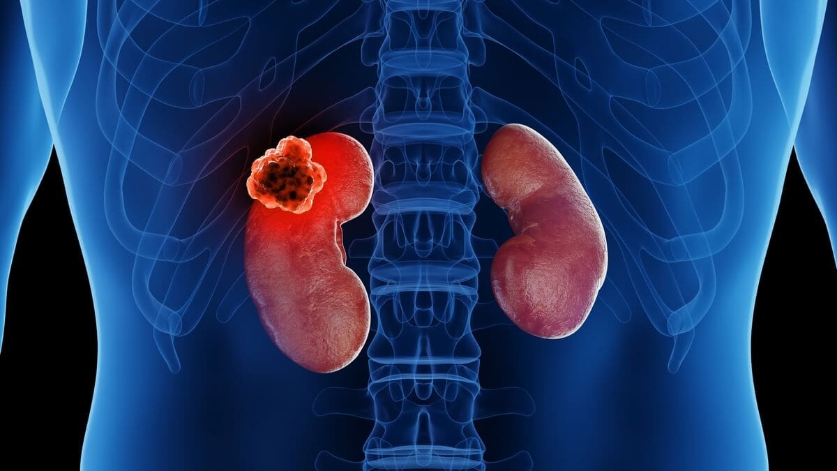 kidney-tumor-2-1