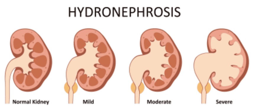 symptoms-of-upj-obstruction