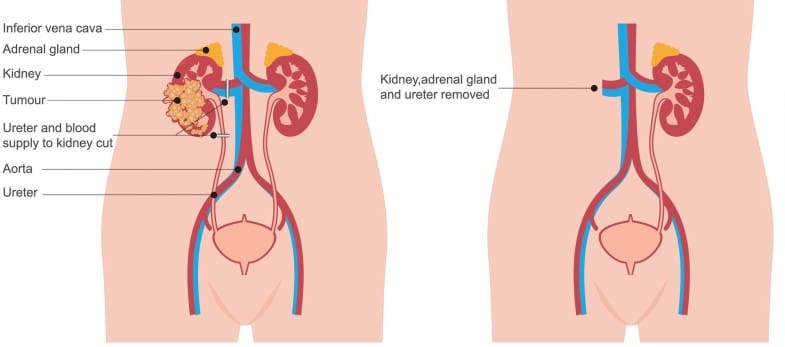 what-is-a-nephroureterectomy