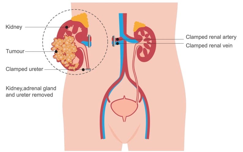 what-is-a-robotic-radical-nephrectomy