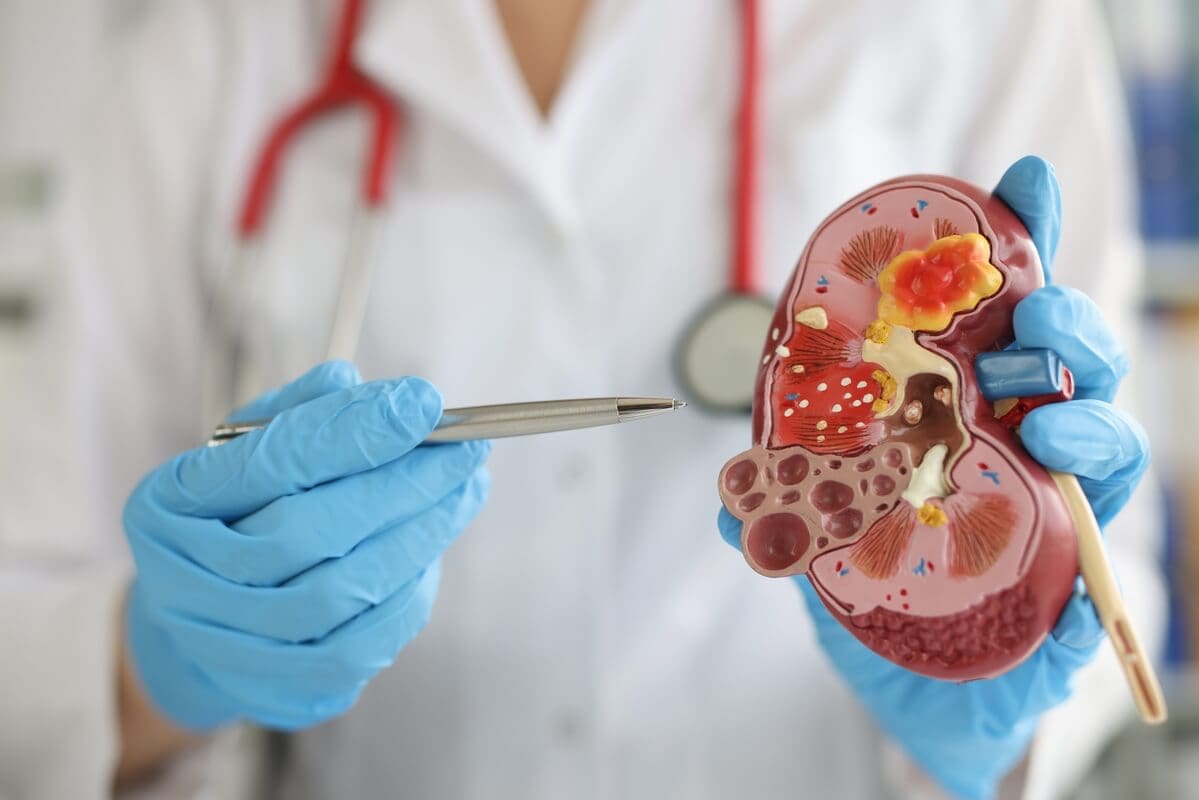 kidney-tumors-2-1