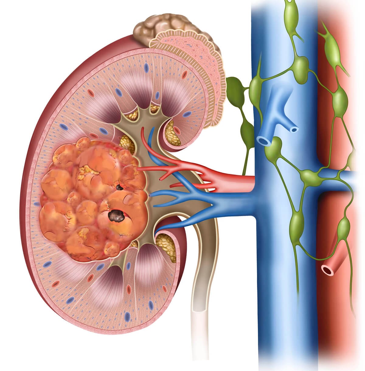radical-nephrectomy-tumor-2-1-1