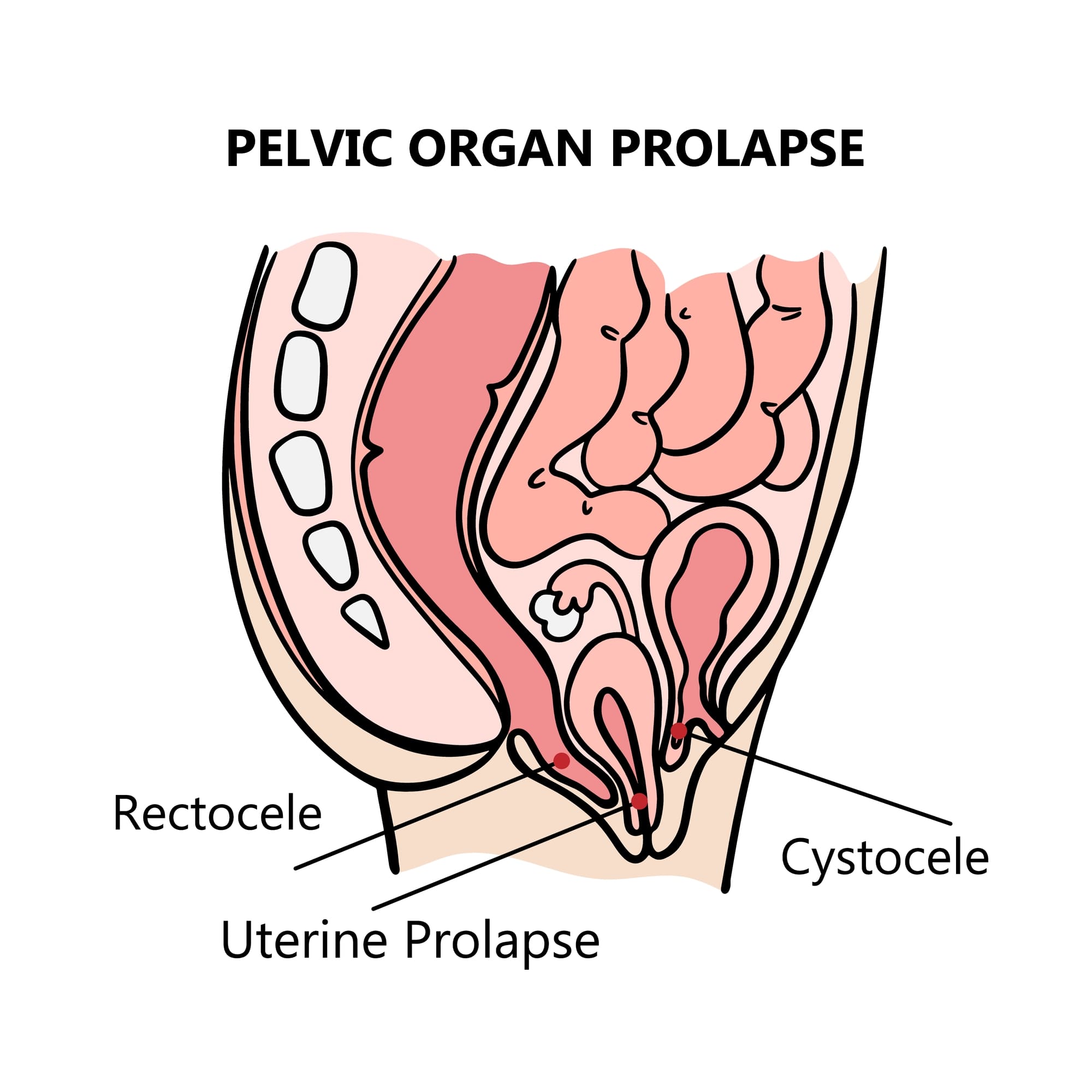 pelvicorganprolapseofwomengeneraldiagramwithexplanatorytext
