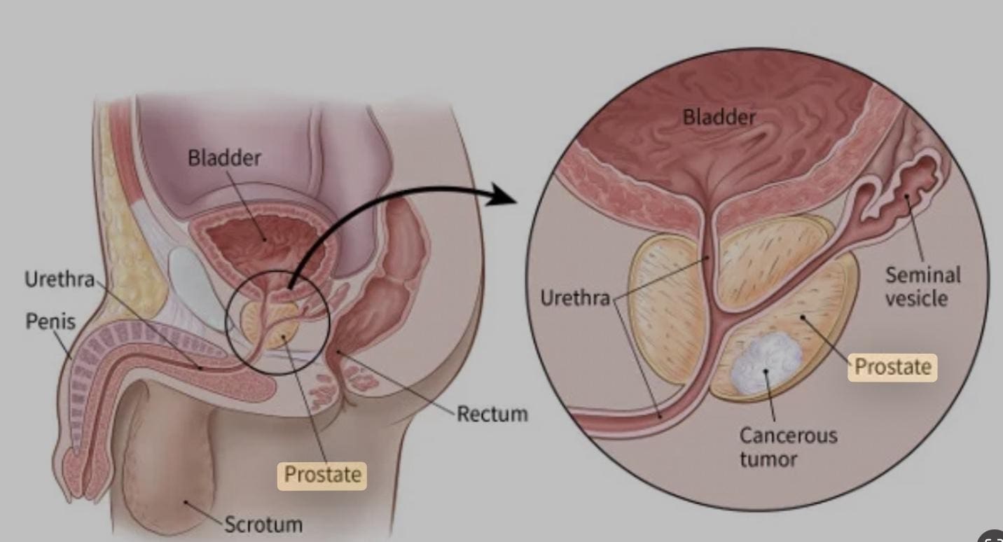 staging-of-cancer