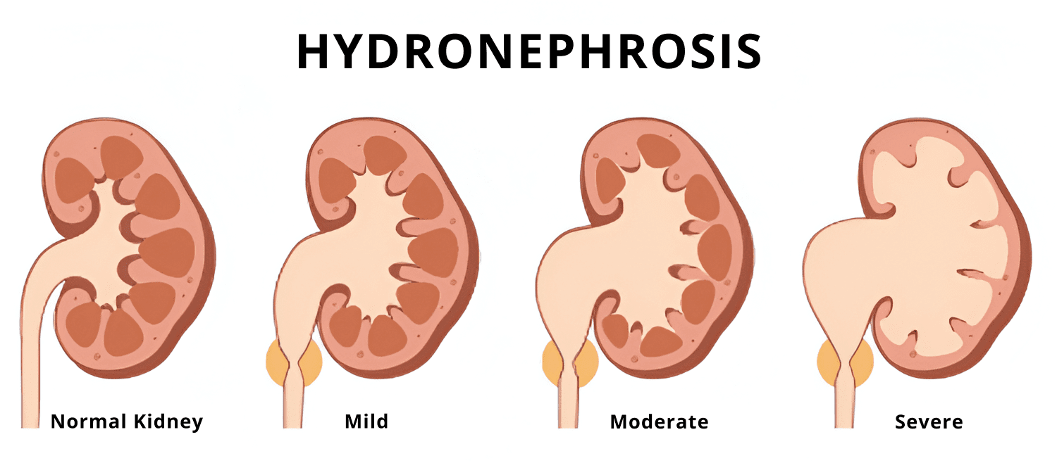 hydronephrosis